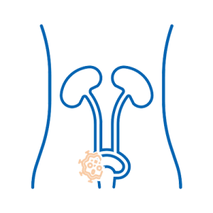 Cystektomia radykalna