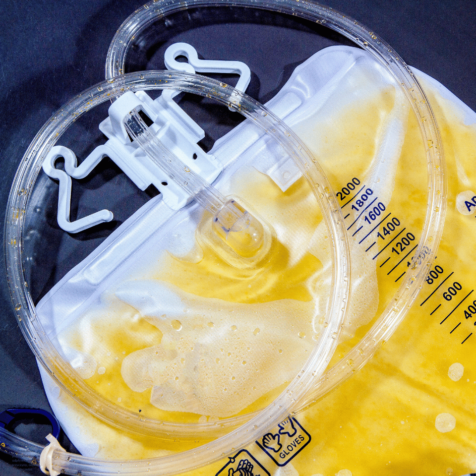 Przeszkoda podpęcherzowa w odpływie moczu – przyczyny, objawy, leczenie