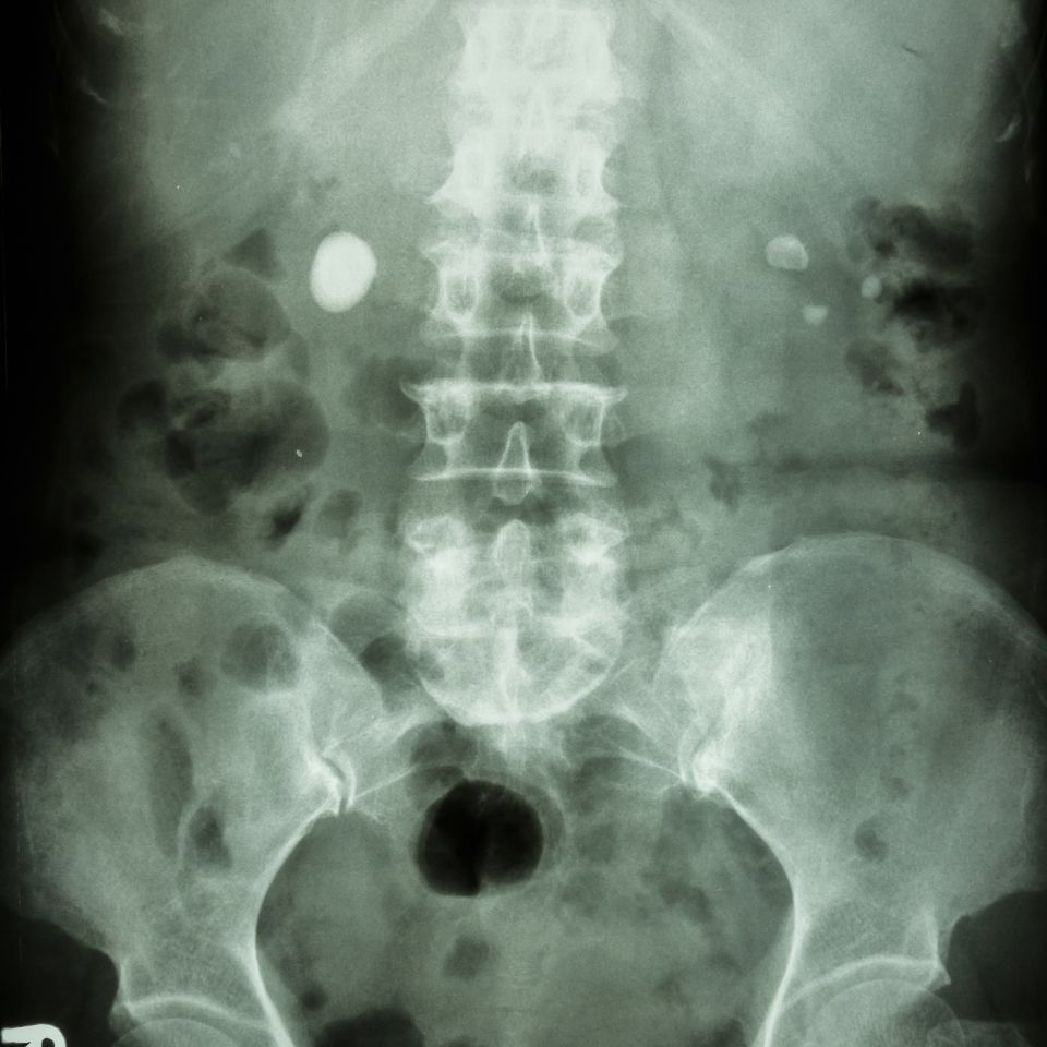 Kamica moczowodowa obustronna – czy jest możliwa i jak leczyć?
