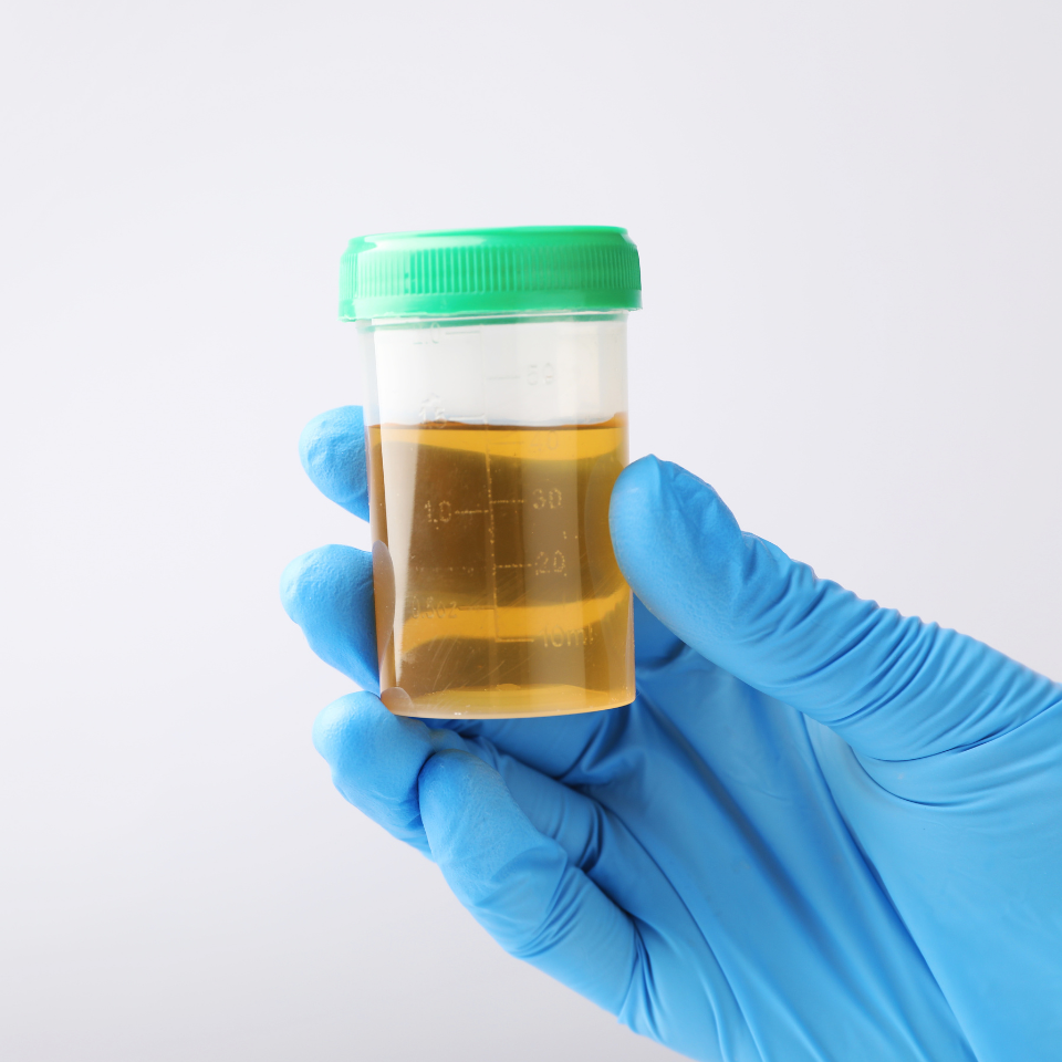 Badanie posiewowe moczu – na czym polega?